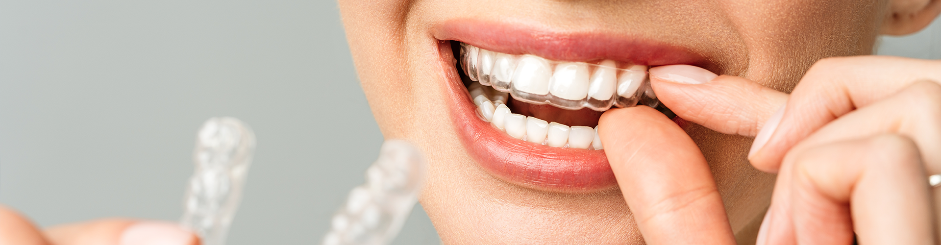 woman placing clear retainer in her mouth